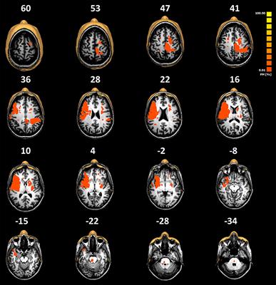 Fractional Anisotropy of <mark class="highlighted">Thalamic Nuclei</mark> Is Associated With Verticality Misperception After Extra-Thalamic Stroke